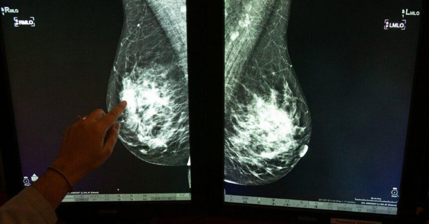 Researchers Identify Possible New Risk for Breast Cancer