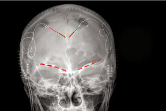 Chronic Pain Linked to Brain Signals in Orbitofrontal Cortex