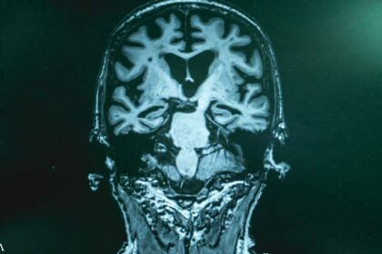 Is Too Much Iron in the Brain Causing Alzheimer's?