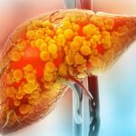 30% of Americans Have Fatty Liver Disease