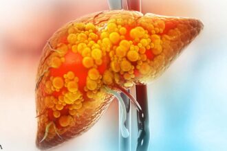 30% of Americans Have Fatty Liver Disease