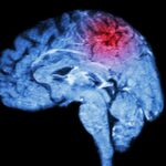 Even Mild Head Injuries Increase Risk for Parkinson's Disease