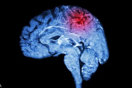 Even Mild Head Injuries Increase Risk for Parkinson's Disease
