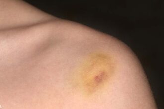 Should This Kind of Bruise Concern You?