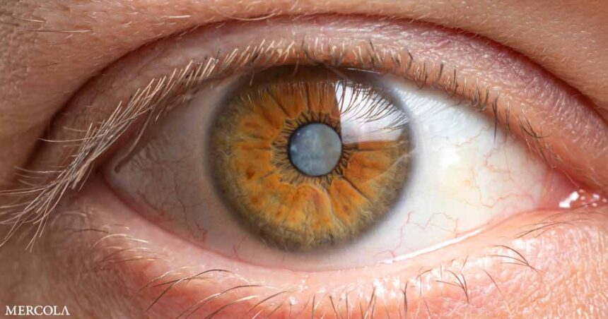 What Can You Do to Help Prevent Cataracts?