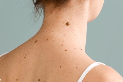 Do Your Moles Ever Go Away?