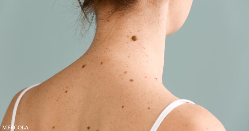 Do Your Moles Ever Go Away?