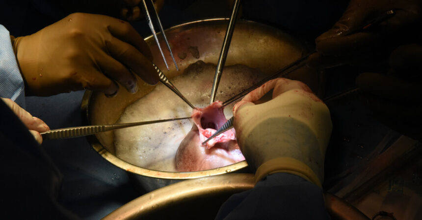 Genetically Modified Pig’s Heart Is Transplanted Into a Second Patient