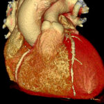 New Gene Editing Treatment Cuts Dangerous Cholesterol in Small Study