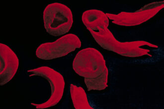 Sickle-Cell Treatment Created With Gene Editing Wins U.K. Approval