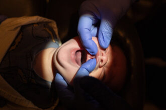 Tongue Tie Surgery: Inside the Business of Cutting Babies’ Tongues