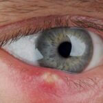 How to Get Rid of a Stye in Your Eye