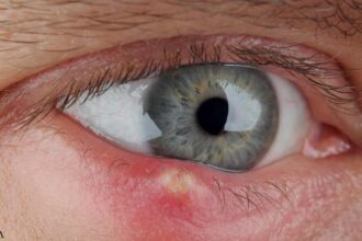 How to Get Rid of a Stye in Your Eye