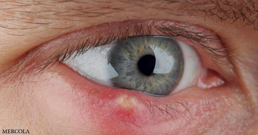 How to Get Rid of a Stye in Your Eye