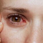 Natural Remedies for the Prevention of Dry Eyes