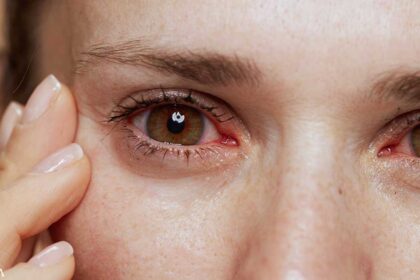 Natural Remedies for the Prevention of Dry Eyes