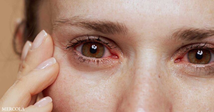 Natural Remedies for the Prevention of Dry Eyes