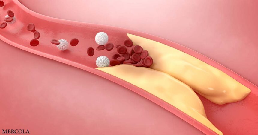 What Are the Effects of Vitamins D3 and K2 on Coronary Artery Disease?