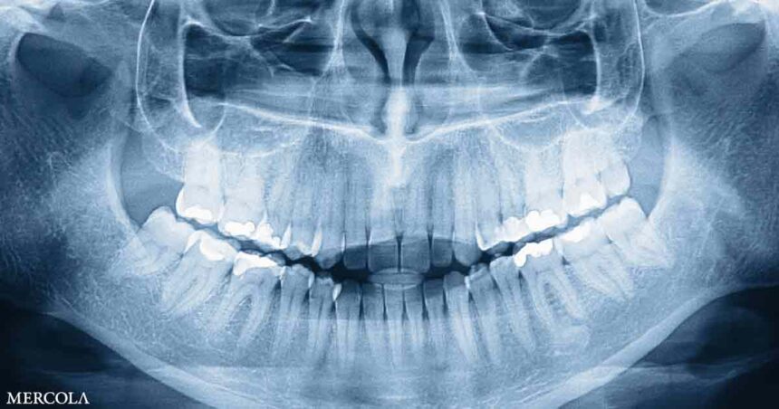 Who Knew Humans Have a Third Set of Teeth?